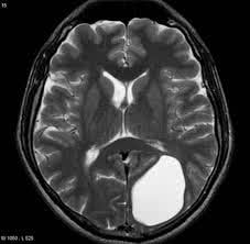 киста головного мозга на МРТ снимке